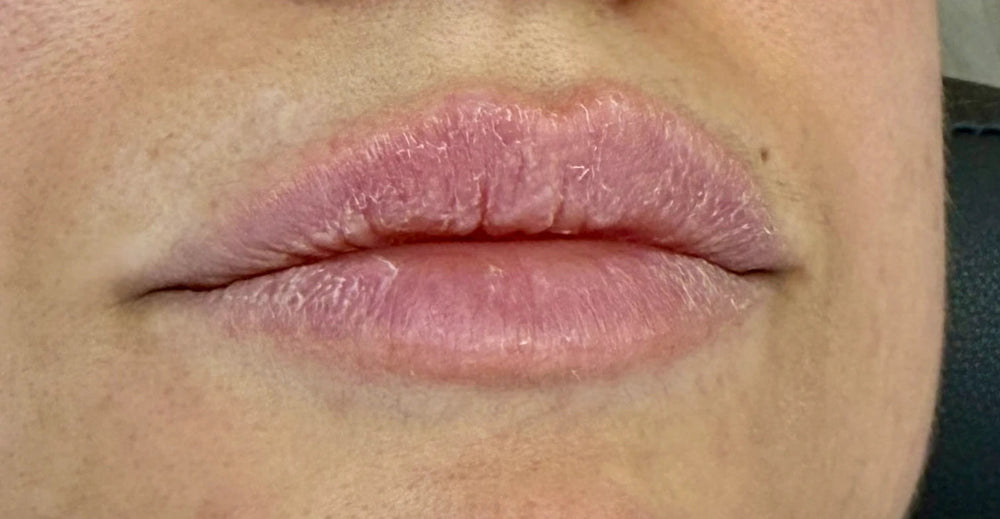 Lip Hydration