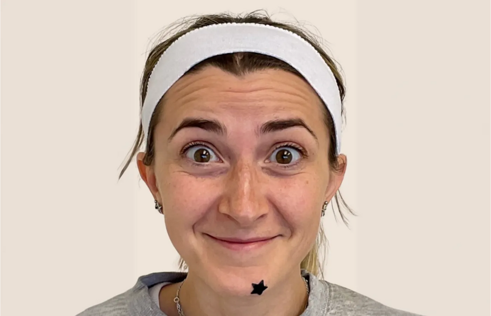 Forehead Botox - Front