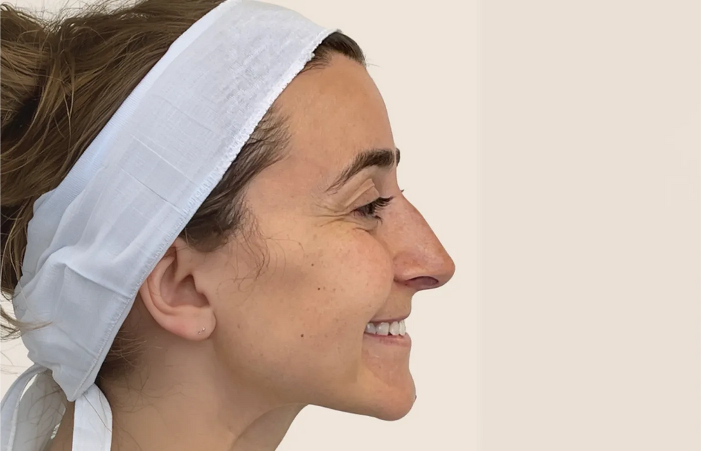 Forehead Botox - Profile