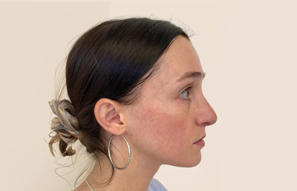 Full Facial Balancing - Profile