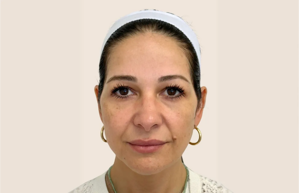Full Facial Balancing - Front