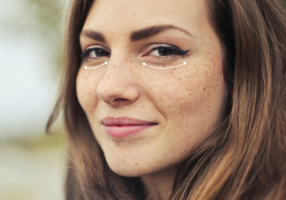Under-Eye Filler