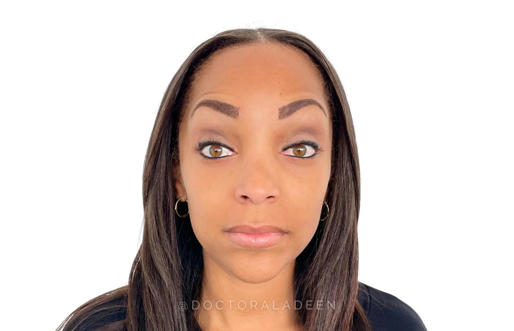 Forehead Botox - Front