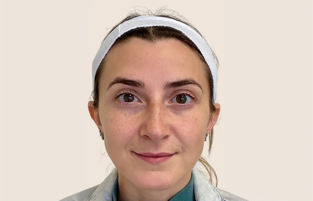 Forehead Botox - Front