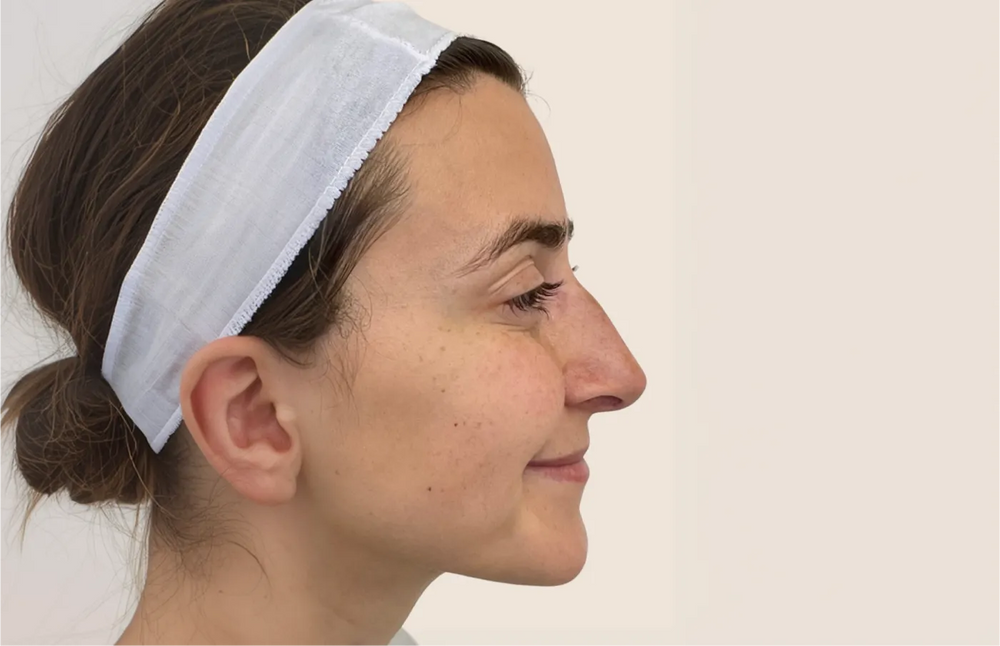 Forehead Botox - Profile