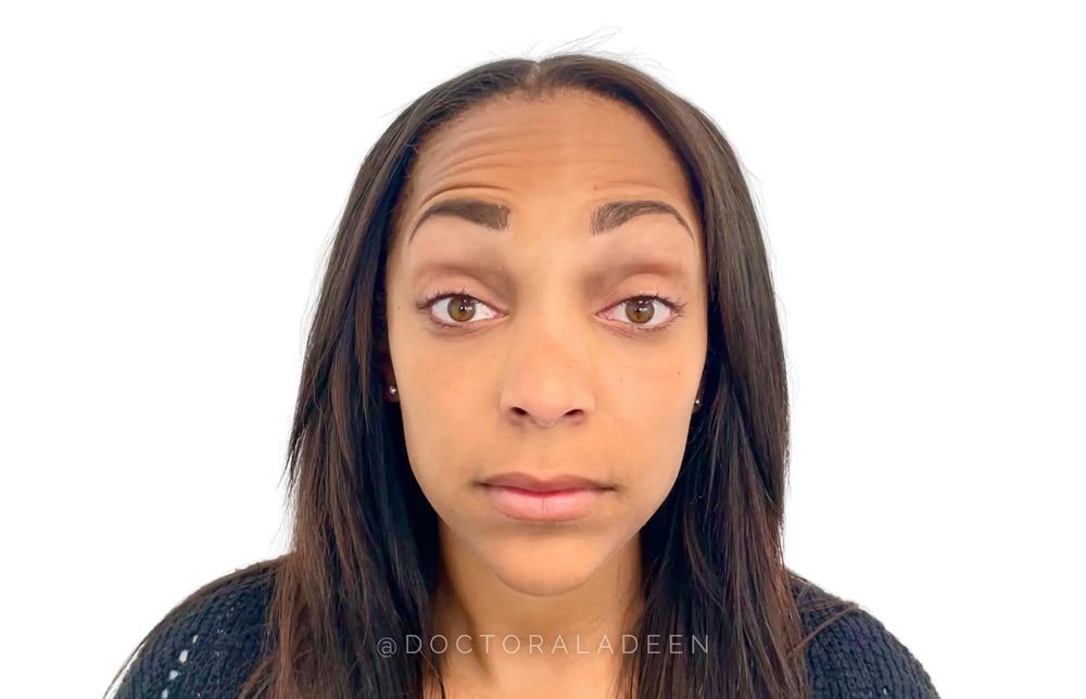 Forehead Botox - Front