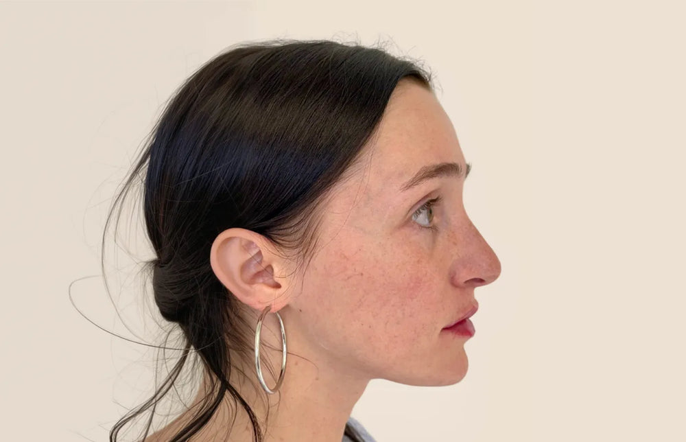 Full Facial Balancing - Profile