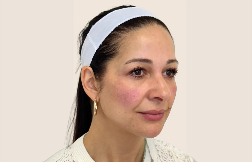 Full Facial Balancing - Side