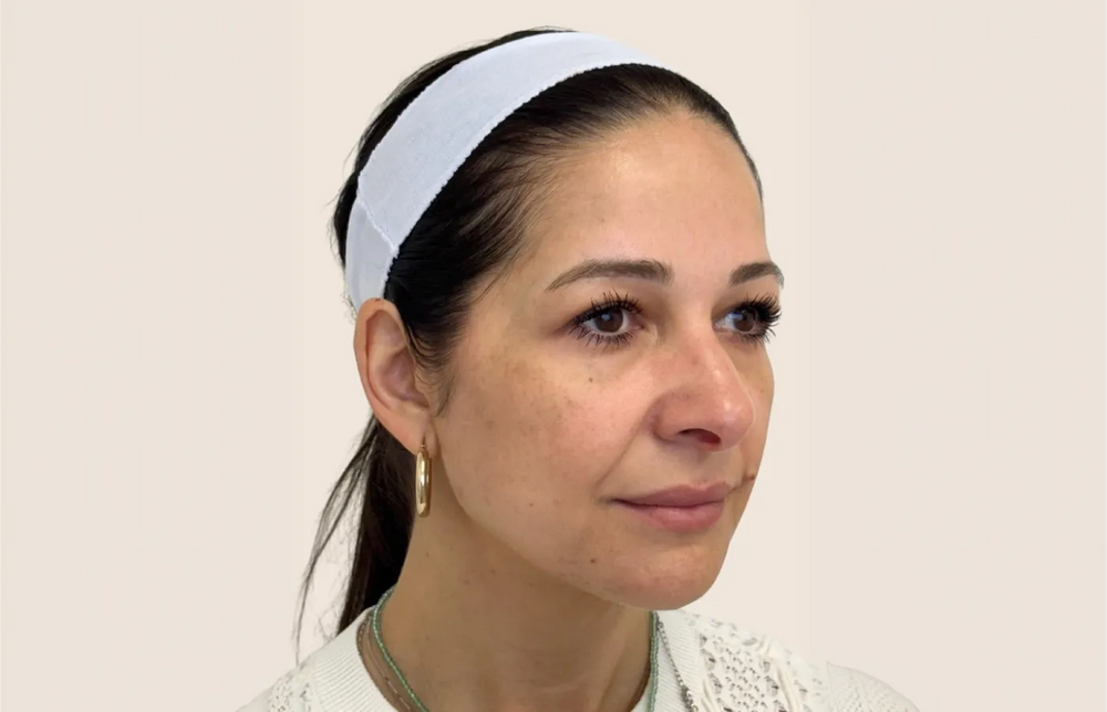Full Facial Balancing - Side