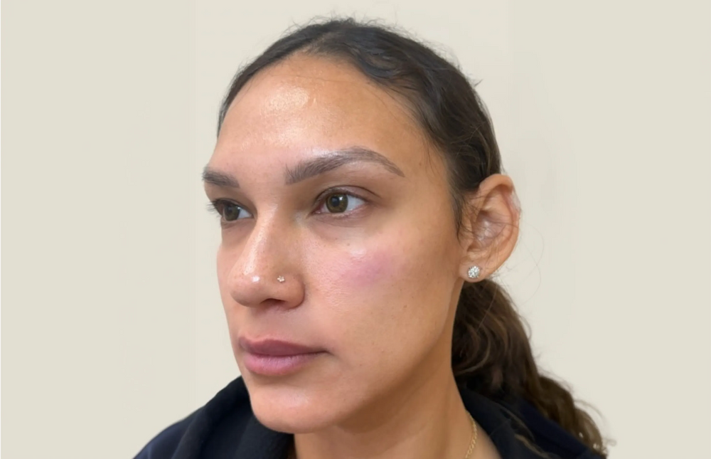 Full Facial Balancing - Side