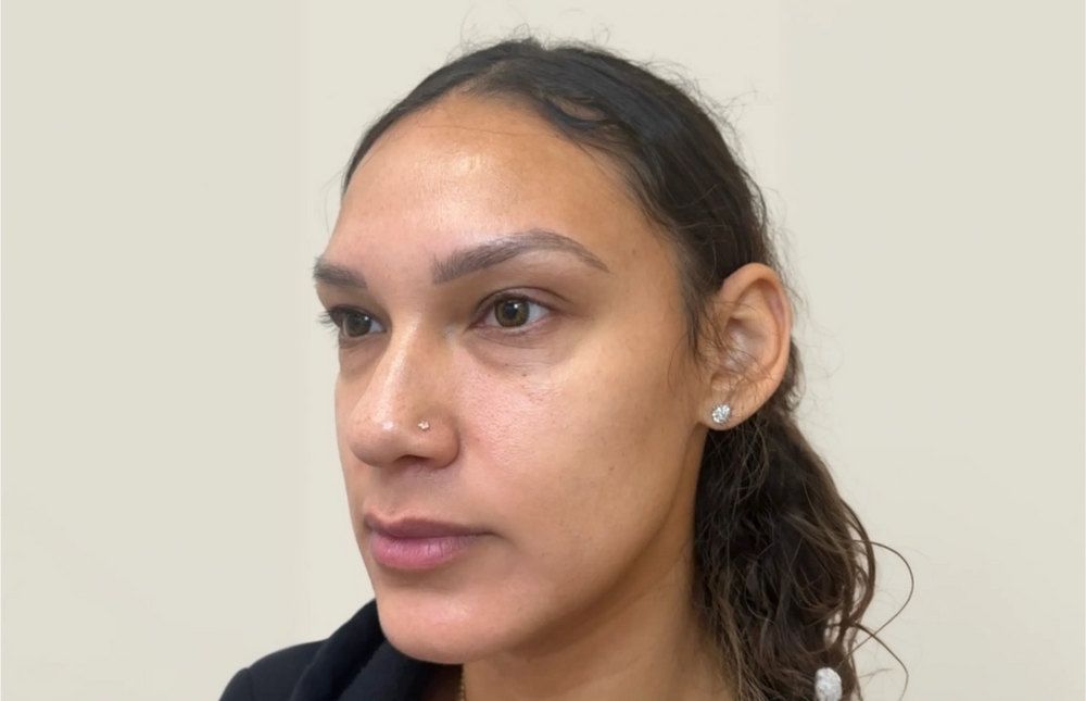 Full Facial Balancing - Side
