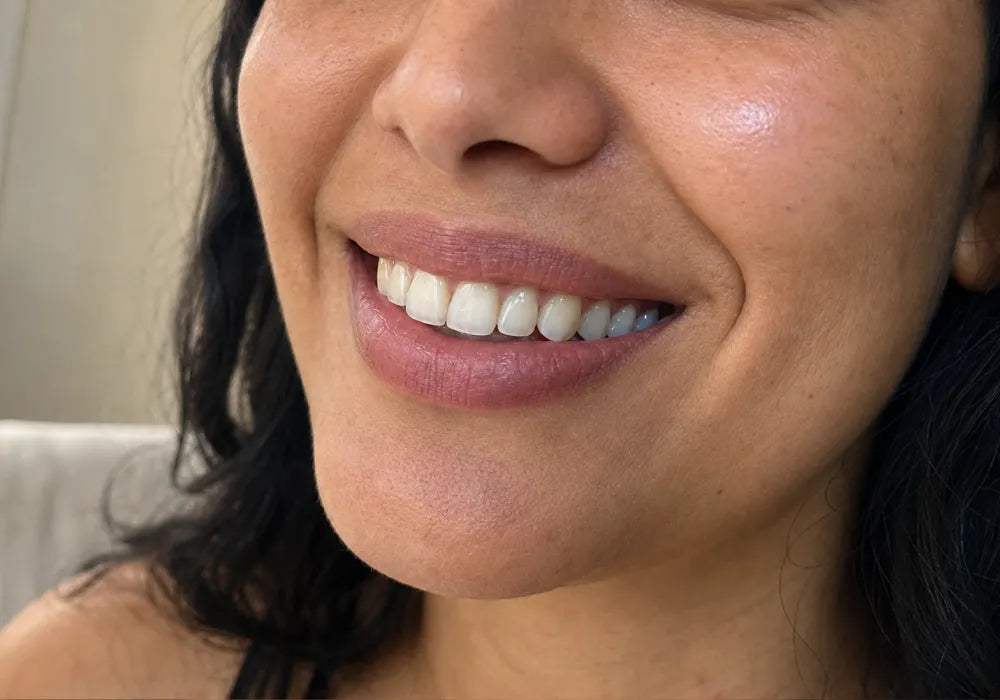 Gummy Smile Botox